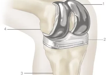 How to Recover from a Total Knee Replacement