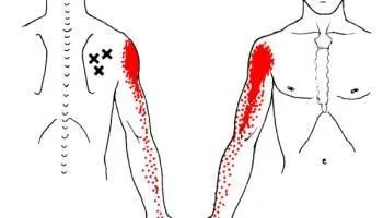 will dry needling help frozen shoulder