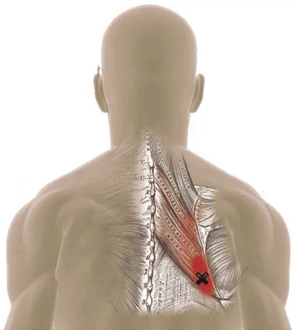 dry needling vs trigger points